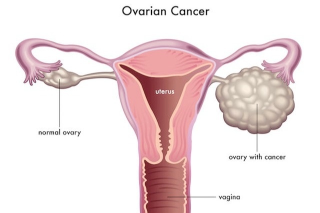 Có các dấu hiệu này, bạn cần đề phòng ung thư buồng trứng